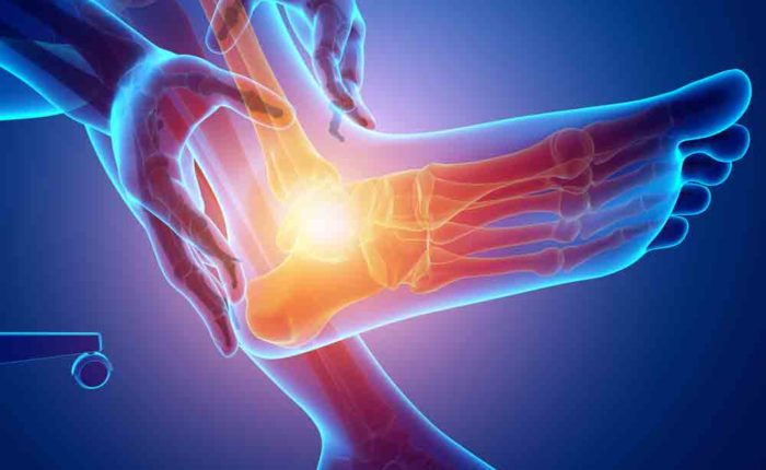 Ankle instability - SOL Physical Therapy + Performance Training Oakland,  Walnut Creek , Berkeley, Alameda, San Francisco