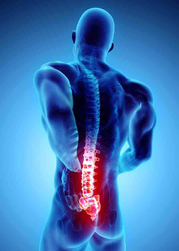 lumbar-radiculopathy-sol-physical-therapy